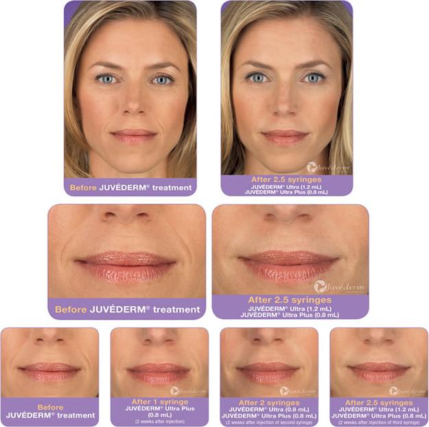 Juv Derm Facial Fillers At Medical Aesthetics Alexandria Va